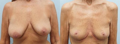 Breast Reduction Before & After Gallery - Patient 113516221 - Image 1