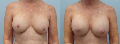 Breast Revision Before & After Gallery - Patient 113516317 - Image 1