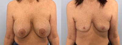 Implant Removal Before & After Gallery - Patient 113516342 - Image 1