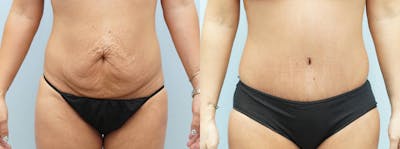 Tummy Tuck Before & After Gallery - Patient 113516360 - Image 1