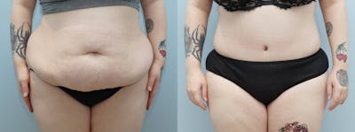 Tummy Tuck Before & After Gallery - Patient 113746476 - Image 1