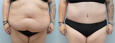 Tummy Tuck Before & After Gallery - Patient 113746490 - Image 1