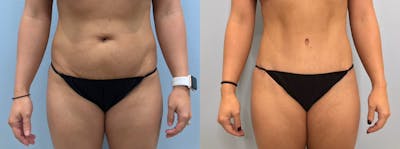 Tummy Tuck Before & After Gallery - Patient 113746589 - Image 1