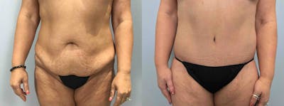 Tummy Tuck Before & After Gallery - Patient 113746610 - Image 1