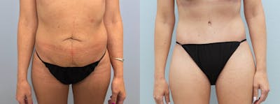 Tummy Tuck Before & After Gallery - Patient 113746667 - Image 1