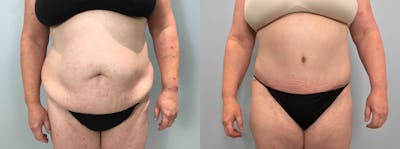 Tummy Tuck Before & After Gallery - Patient 113755423 - Image 1