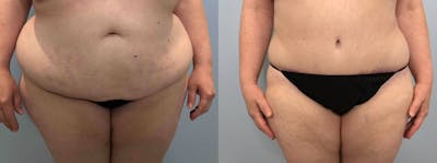 Tummy Tuck Before & After Gallery - Patient 113755474 - Image 1