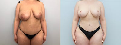 Mommy Makeover Before & After Gallery - Patient 117693083 - Image 1