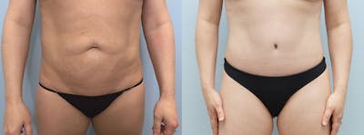 Tummy Tuck Before & After Gallery - Patient 118355039 - Image 1