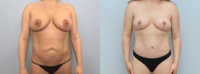 Mommy Makeover Before & After Gallery - Patient 118358761 - Image 1