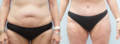 Tummy Tuck Gallery - Patient 121336885 - Image 1