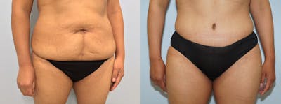 Tummy Tuck Before & After Gallery - Patient 121336944 - Image 1