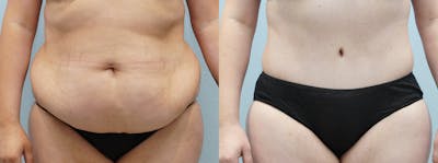 Tummy Tuck Before & After Gallery - Patient 121336965 - Image 1