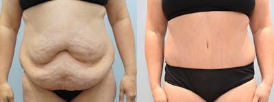 Body Lift Before & After Gallery - Patient 121336990 - Image 1
