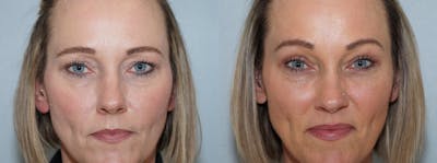 Eyelid Surgery Before & After Gallery - Patient 121337019 - Image 1