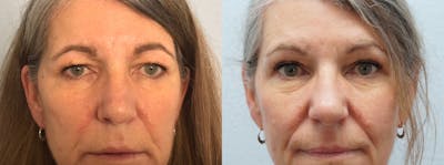 Eyelid Surgery Before & After Gallery - Patient 121337027 - Image 1