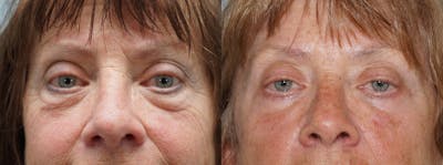 Eyelid Surgery Before & After Gallery - Patient 121337104 - Image 1