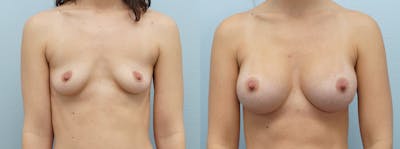 Breast Augmentation Before & After Gallery - Patient 121337489 - Image 1