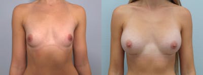 Breast Augmentation Before & After Gallery - Patient 121337491 - Image 1