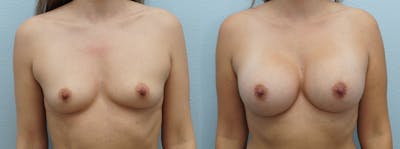 Breast Augmentation Before & After Gallery - Patient 121337492 - Image 1
