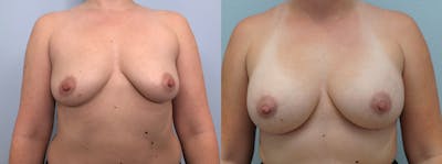 Breast Augmentation Before & After Gallery - Patient 121337493 - Image 1