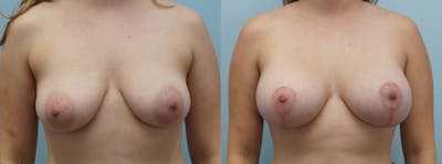 Breast Lift With Implants Before & After Gallery - Patient 121337634 - Image 1