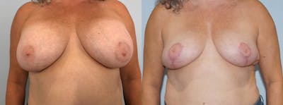 Implant Removal Before & After Gallery - Patient 121337737 - Image 1