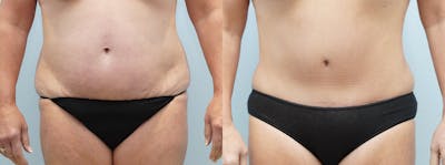 Tummy Tuck Before & After Gallery - Patient 121337818 - Image 1