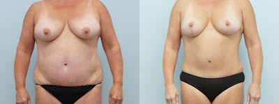 Mommy Makeover Before & After Gallery - Patient 121337836 - Image 1