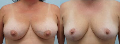 Breast Lift Before & After Gallery - Patient 121337878 - Image 1