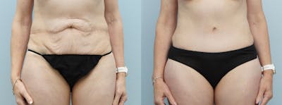Tummy Tuck Before & After Gallery - Patient 121337955 - Image 1