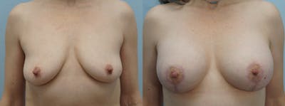 Breast Lift With Implants Before & After Gallery - Patient 121337957 - Image 1