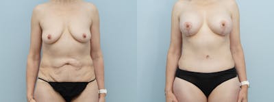 Mommy Makeover Before & After Gallery - Patient 121337979 - Image 1