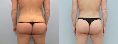 Liposuction Before & After Gallery - Patient 121338122 - Image 1