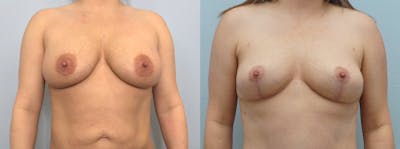 Implant Removal Before & After Gallery - Patient 121338125 - Image 1