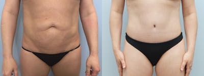 Tummy Tuck Before & After Gallery - Patient 121338159 - Image 1