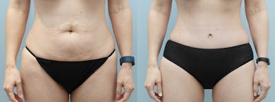 Body Lift Before & After Gallery - Patient 121338209 - Image 1