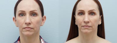 Otoplasty Before & After Gallery - Patient 121338223 - Image 1