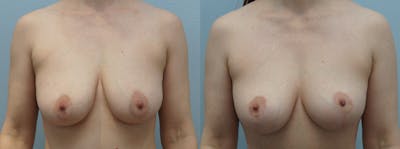 Breast Lift Before & After Gallery - Patient 121338264 - Image 1