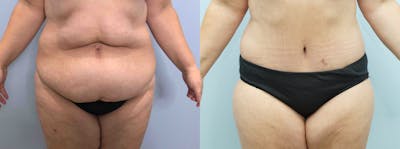 Body Lift Before & After Gallery - Patient 121400868 - Image 1
