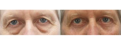 Eyelid Surgery Before & After Gallery - Patient 53582643 - Image 1