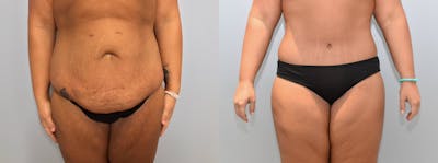 Body Lift Before & After Gallery - Patient 121815531 - Image 1