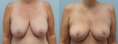 Implant Removal Before & After Gallery - Patient 121815550 - Image 1