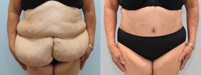 Tummy Tuck Before & After Gallery - Patient 121815610 - Image 1