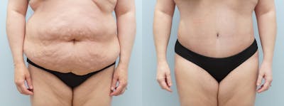 Tummy Tuck Before & After Gallery - Patient 121815611 - Image 1