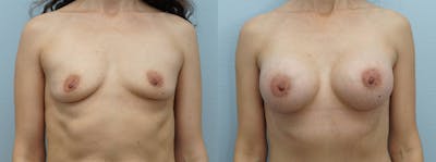 Breast Augmentation Before & After Gallery - Patient 121815647 - Image 1