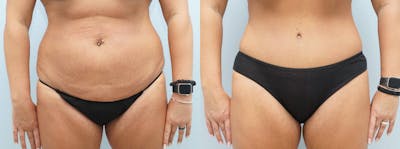 Tummy Tuck Before & After Gallery - Patient 121816131 - Image 1
