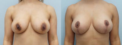 Breast Lift Before & After Gallery - Patient 121816235 - Image 1