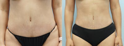 Liposuction Before & After Gallery - Patient 121816308 - Image 1