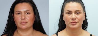 Liposuction Before & After Gallery - Patient 121817932 - Image 1